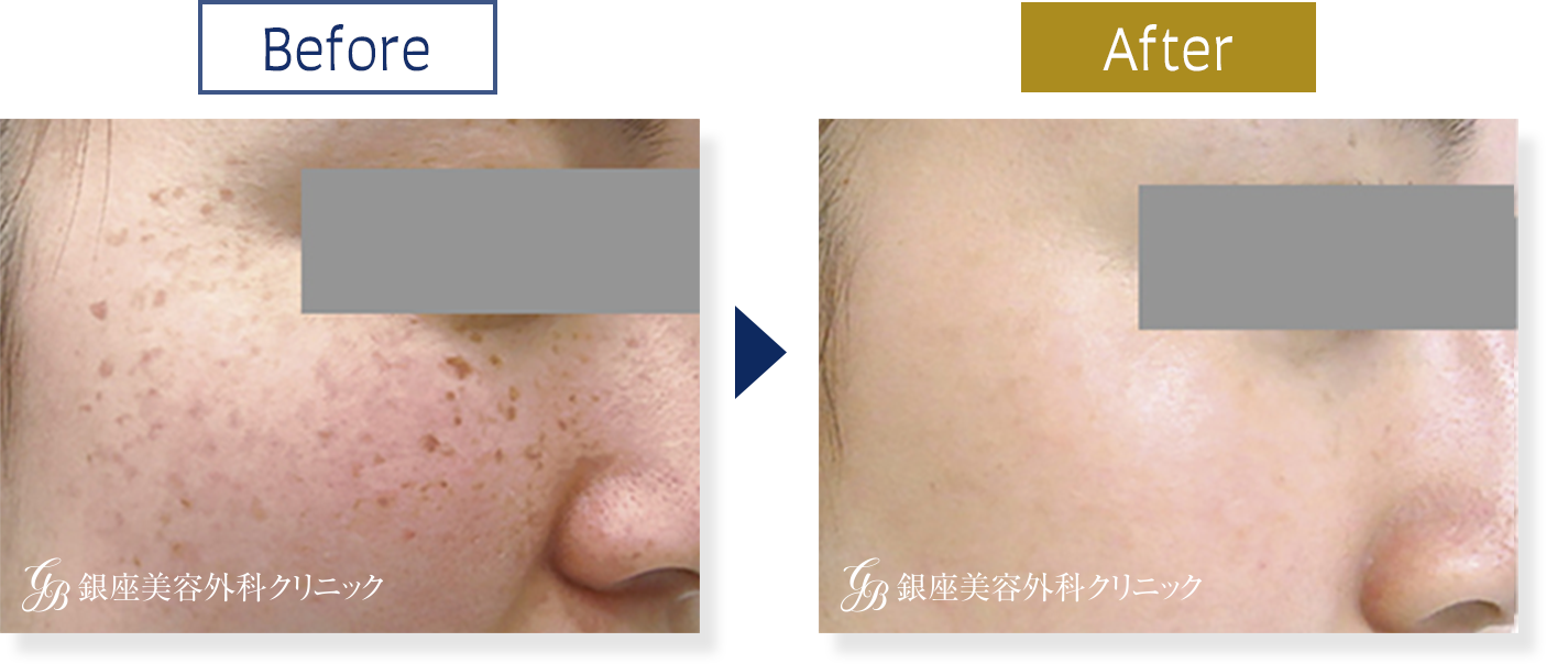 シミ取りレーザー治療&シミ取り放題 | 美容皮膚科・銀座美容外科クリニック