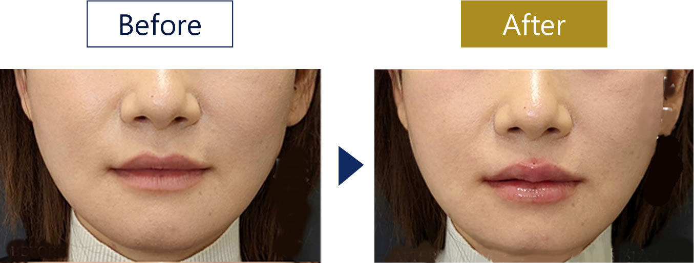 シミ取りレーザー治療&シミ取り放題 | 美容皮膚科・銀座美容外科クリニック