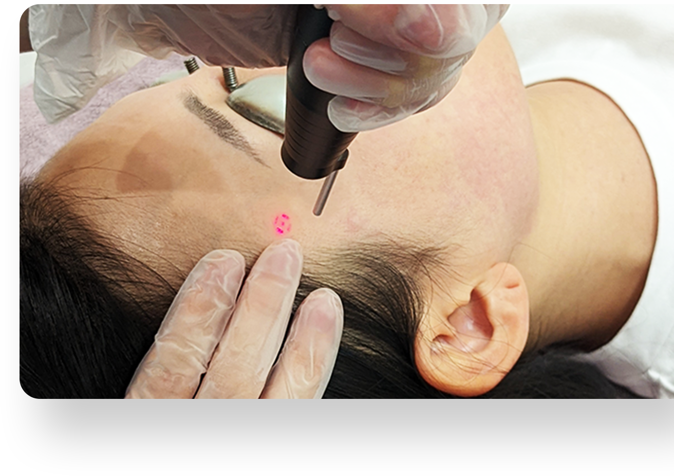 シミ取りレーザー治療&シミ取り放題 | 美容皮膚科・銀座美容外科クリニック